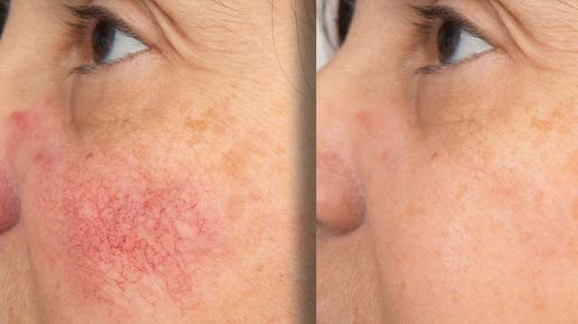 Glowrie Redness Relief Serum