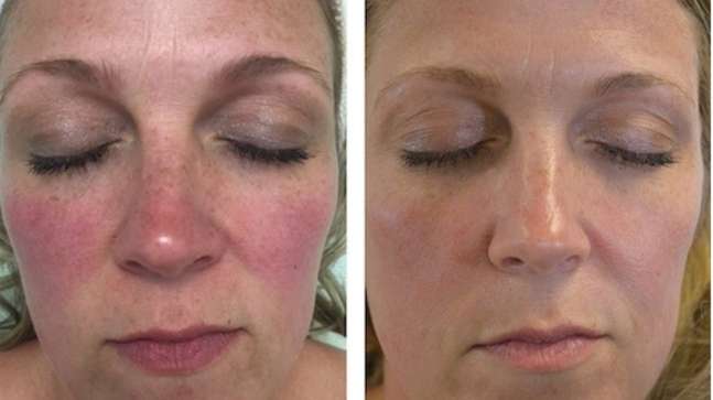 Glowrie Redness Relief Serum